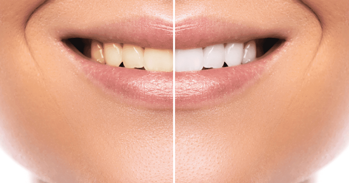 Teeth Whitening Options: Which One Is Right for You?