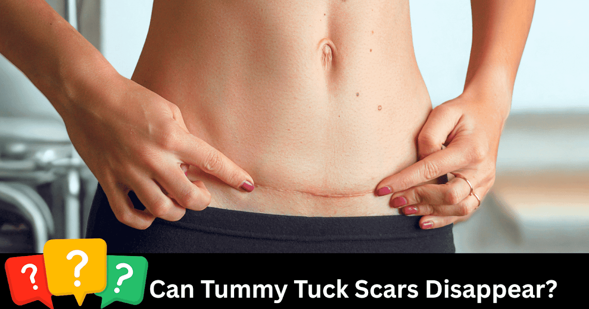 Do Tummy Tuck Scars Disappear—Or Can They Become a Masterpiece? Do Tummy Tuck Scars Disappear—Or Can They Become a Masterpiece?