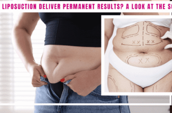 Does Liposuction Deliver Permanent Results? A Look at the Science