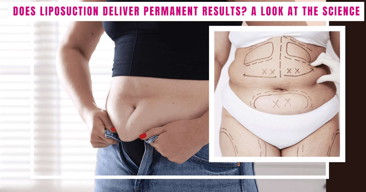 Does Liposuction Deliver Permanent Results? A Look at the Science