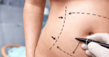 How Does Liposculpture Work? A Step-by-Step Look at the Procedure